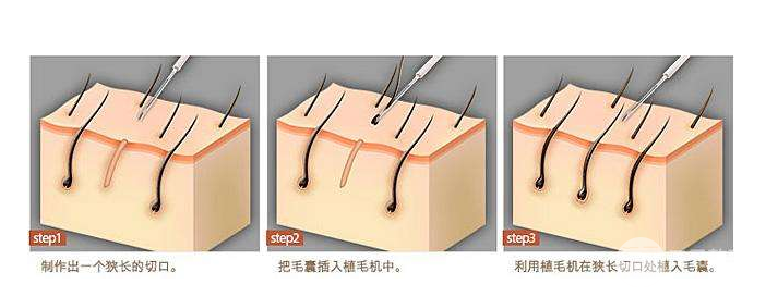 5000块可以植发吗