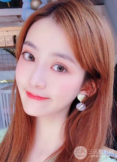 临沂瑞丽美容医院双眼皮案例欣赏