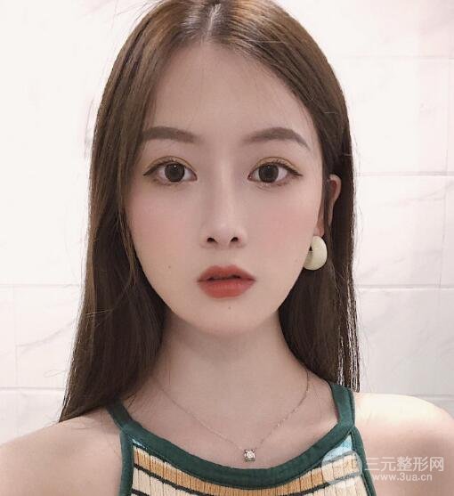 临沂瑞丽美容医院双眼皮案例欣赏