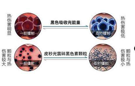 激光美容祛斑价格