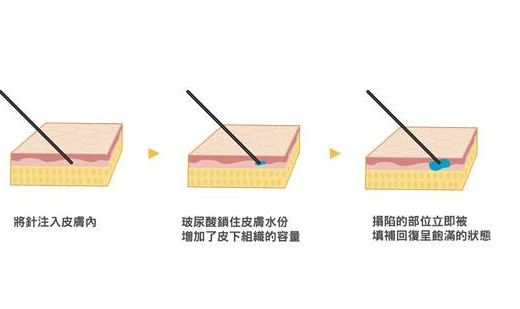 透明质酸玻尿酸的用处