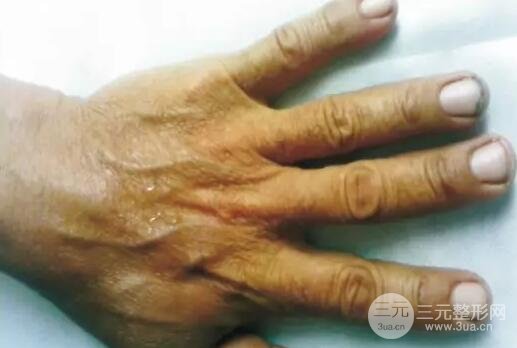 注射瘦脸治疗水源性肢端角化症