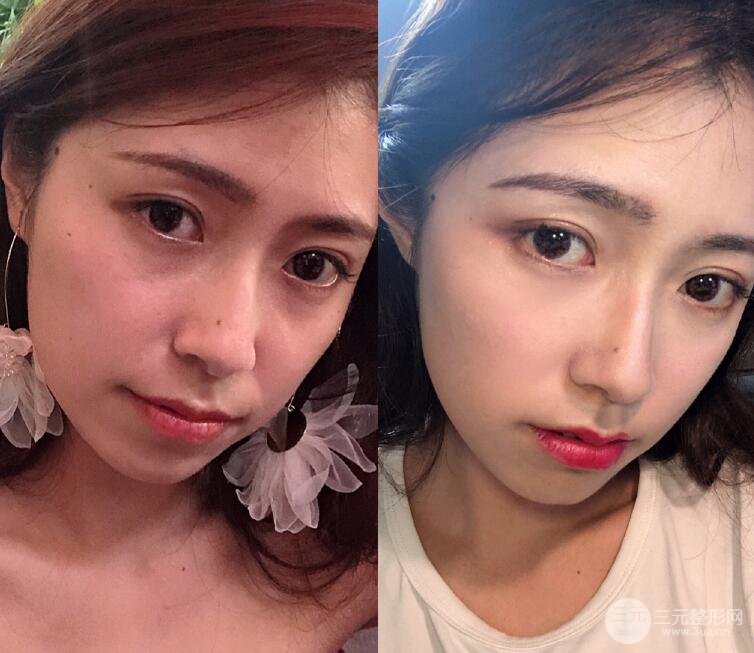 热玛吉体验分享