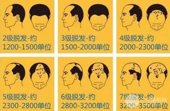 如何判断自己需要移植的毛囊数量?