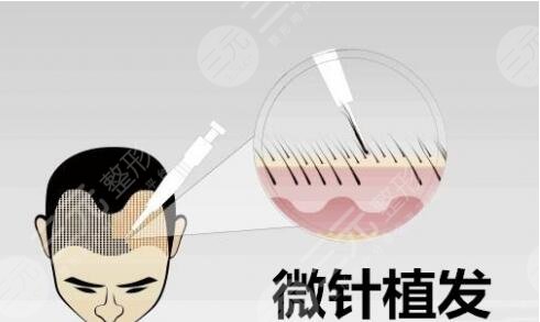 微针植发是什么技术?