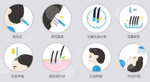 微针植发后头发容易脱落吗?