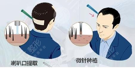 微针植发有什么优势?