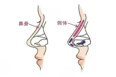 决定假体隆鼻顺利的几个原因
