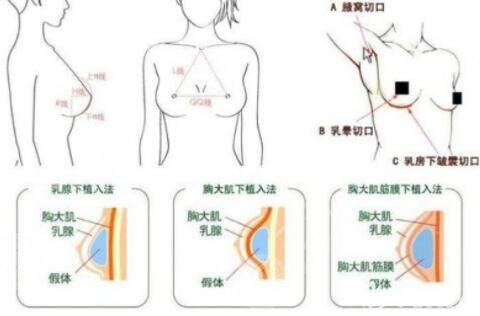 世纪坛医院做隆胸手术案例