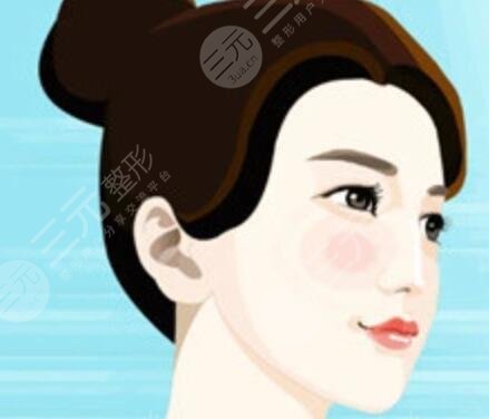 宝鸡人民医院整形美容科隆鼻手术后5周