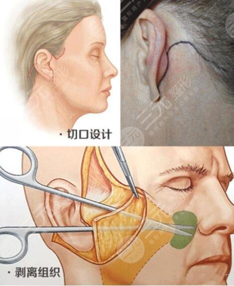 北京八大处拉皮手术案例