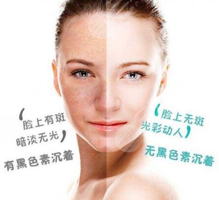 湘雅附二医院激光祛斑案例