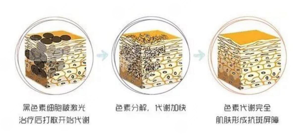 激光去雀斑的果可以维持多久?