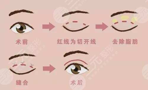 双眼皮手术吃什么可以帮助恢复?