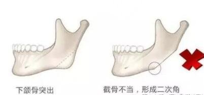 下颌角整形