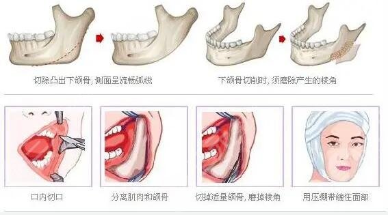 八大处磨骨案例