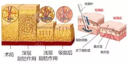 吸脂抽脂手术多长时间可以恢复?