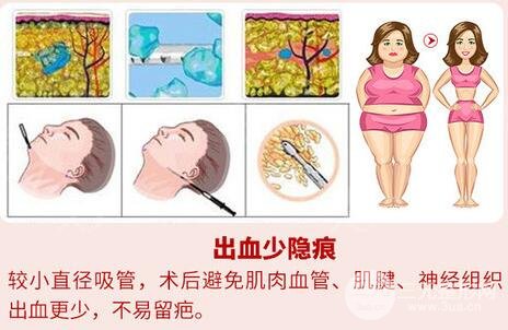 华侨医院美容科吸脂技术