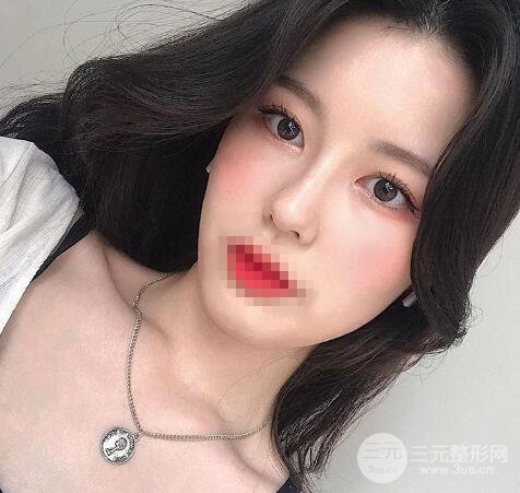 湘潭中心医院美容科双眼皮案例 价格