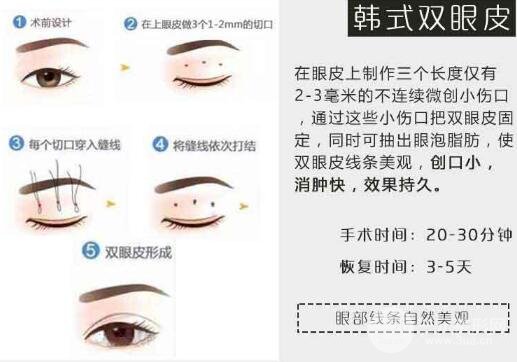 徐医附院美容整容医院割双眼皮技术