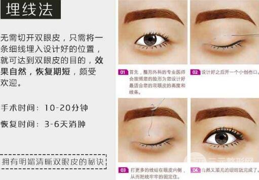 恩泽医院做双眼皮技术