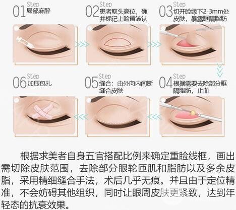 恩泽医院做双眼皮怎么样