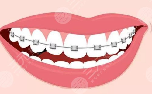 牙齿矫正