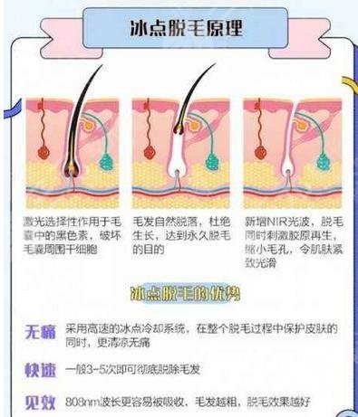 冰点脱毛