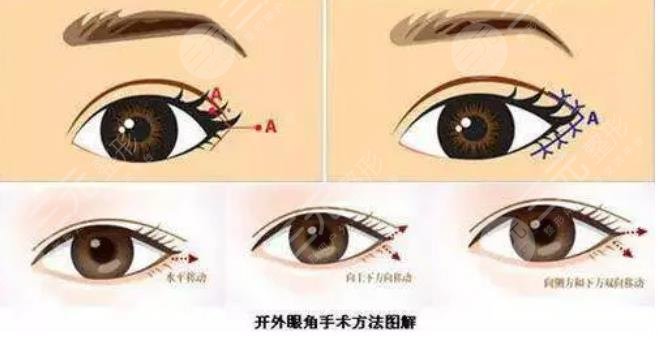 什么是开外眼角?