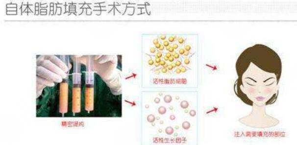 北京协和医院整形科自体脂肪填充面颊项目案例体验反馈: