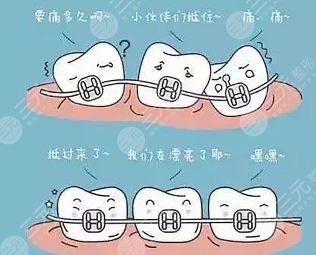 金属牙齿矫正