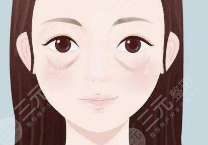濮阳市人民医院整形科去眼袋案例术前