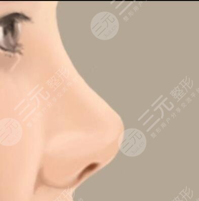 医院隆鼻整形案例
