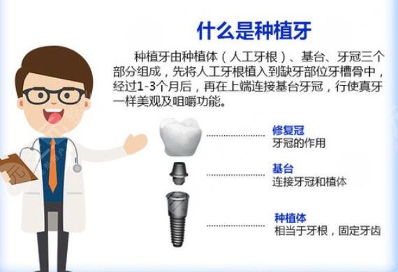 上海华美种植牙项目科普