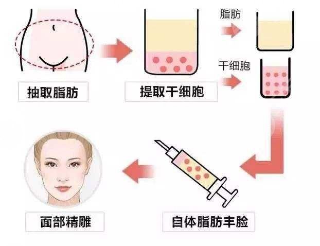 上海九院脂肪填充技术科普