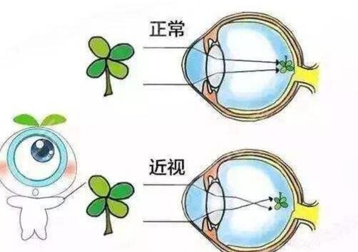近视眼激光手术会不会出现失败的情况?