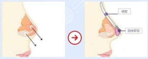 脂肪隆鼻