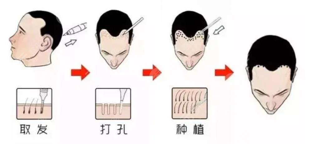 什么是微针植发技术?