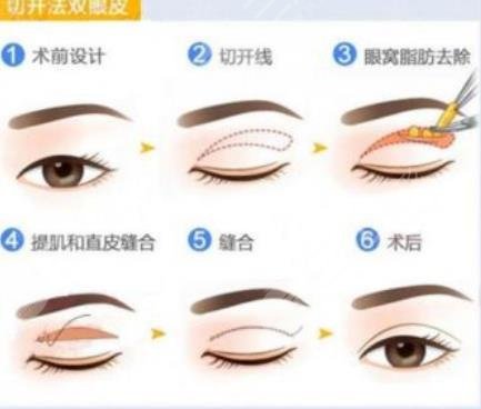 全切双眼皮+开眼角整形概念