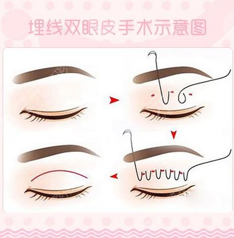 微创双眼皮手术原理