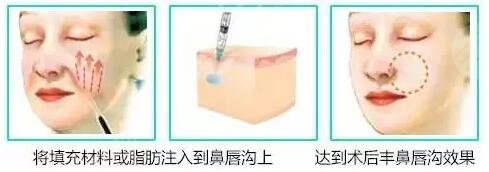 成都脂肪填充技术科普