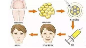 自体脂肪填充面部的禁忌症