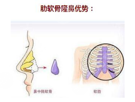 深圳地区热门项目科普：隆鼻