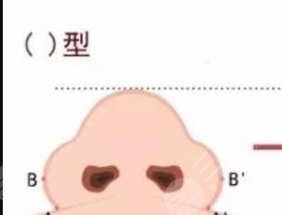 协和医院整形外科怎么样,附黄久佐医生隆鼻案例~