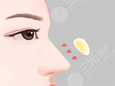 北京爱美整形正规吗？医生实力点评丨注射玻尿酸隆鼻案例~