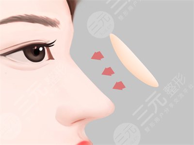 艺兴整形医院隆鼻整形案例
