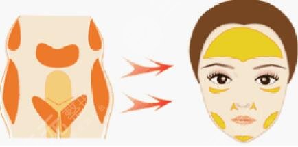 自体脂肪填充面颊有哪些副作用?