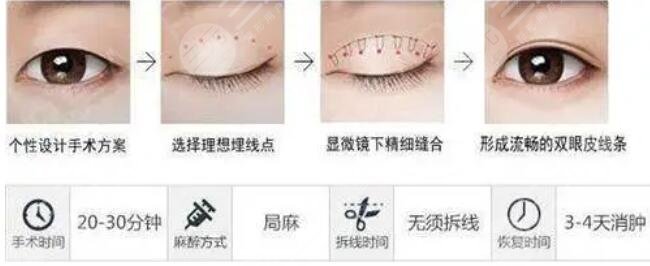 埋线双眼皮手术好吗?