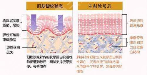 玻尿酸除皱的恢复期久吗?