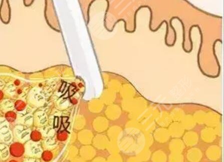 北京八大处医院吸脂怎么样?大腿吸脂案例及收费详情一览~